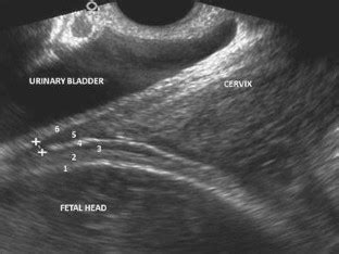 scar thickness for normal delivery